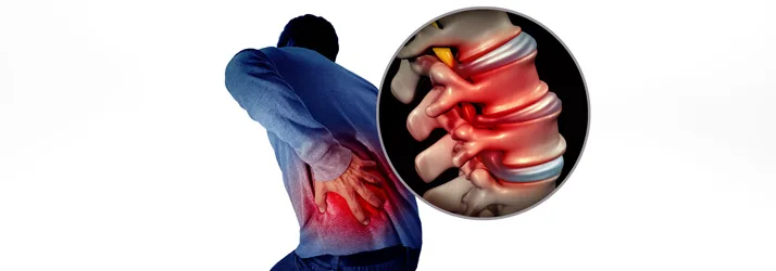Chiropractic Ottawa ON Back Pain Shingles